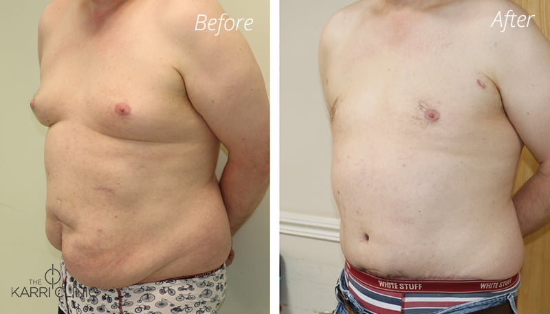 male-breast-surgery2