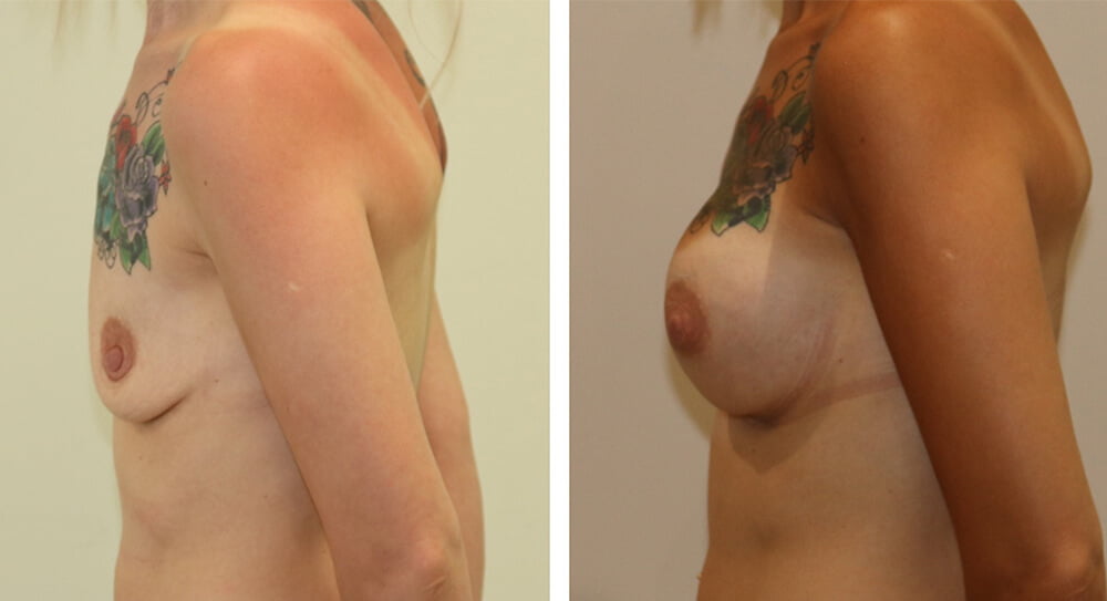 Breast enlargement 3