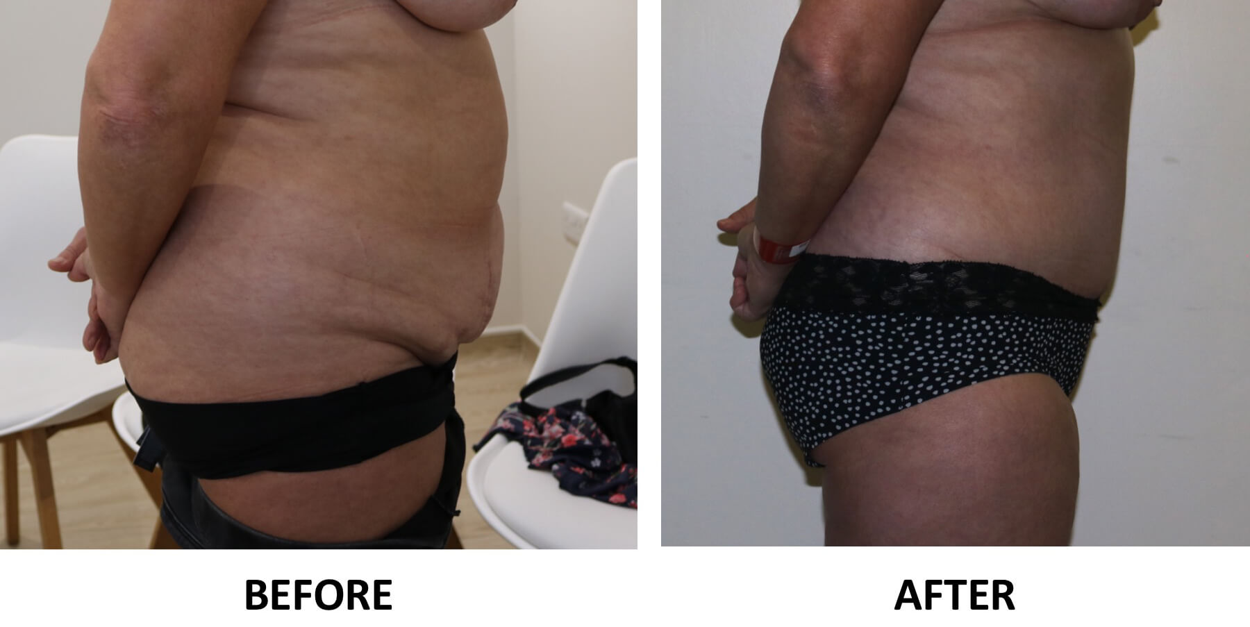 Tummy tuck before and after right lateral view