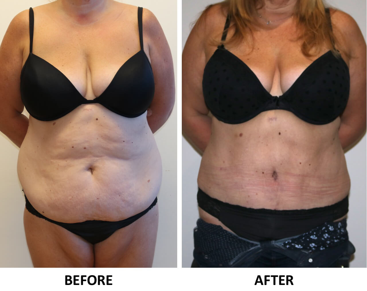 Brazilian tummy tuck AP view patient 1