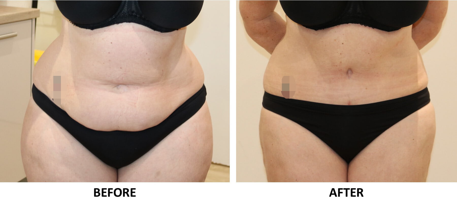 Brazilian tummy tuck AP view