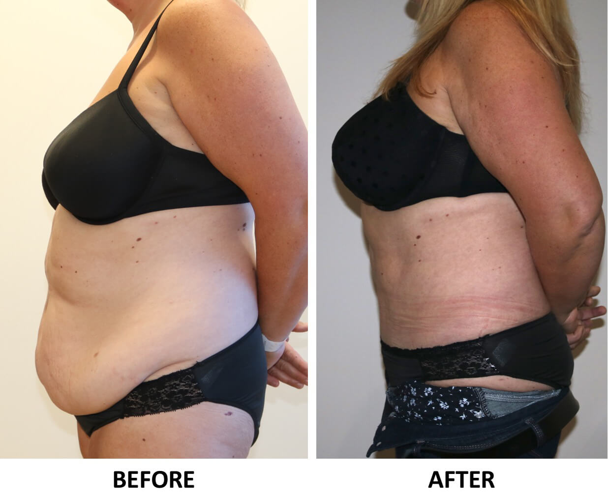 Brazilian tummy tuck left lateral view patient 1