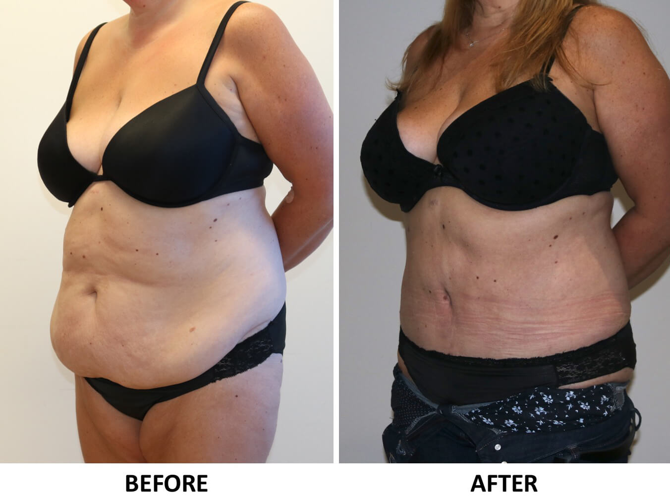 Brazilian tummy tuck left oblqiue view patient 1