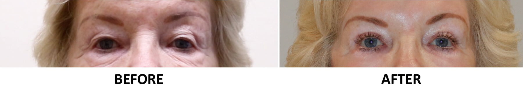 Direct brow lift upper eyelid surgery phenol peel AP view
