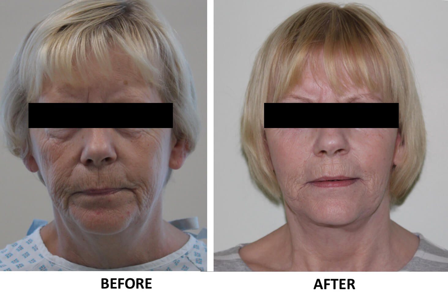 Facelift necklift AP view