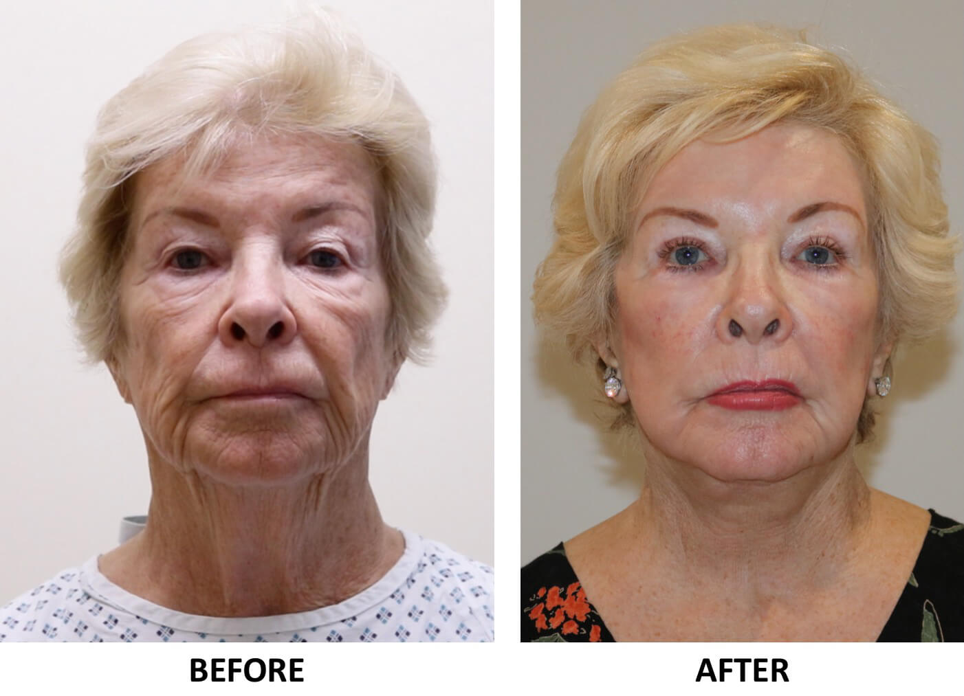 Facelift necklift direct brow lift upper eyelid surgery phenol peel AP view