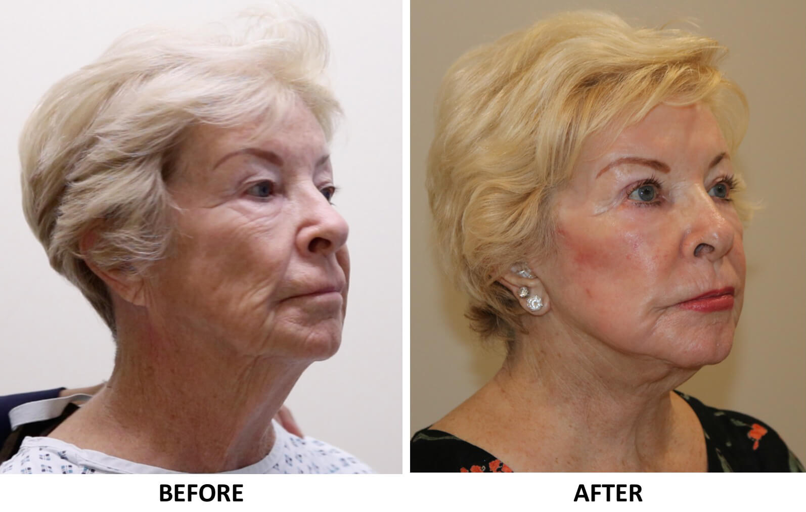 Facelift necklift direct brow lift upper eyelid surgery phenol peel right oblique view