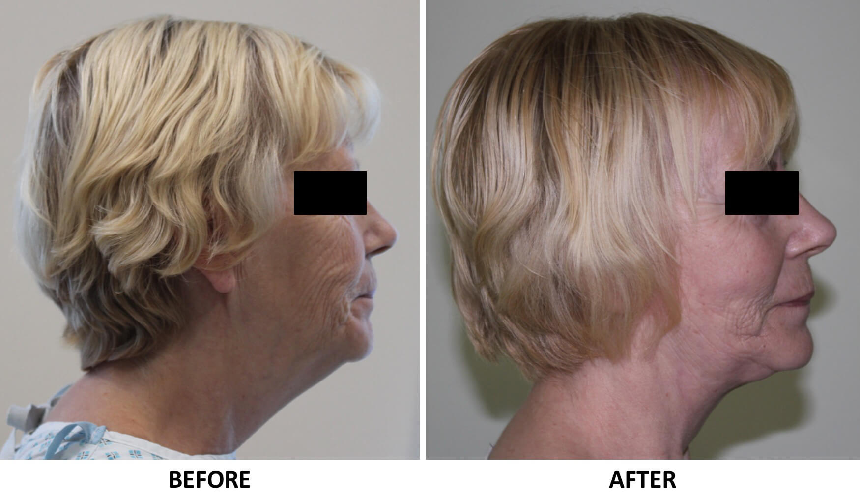 Facelift necklift right lateral view