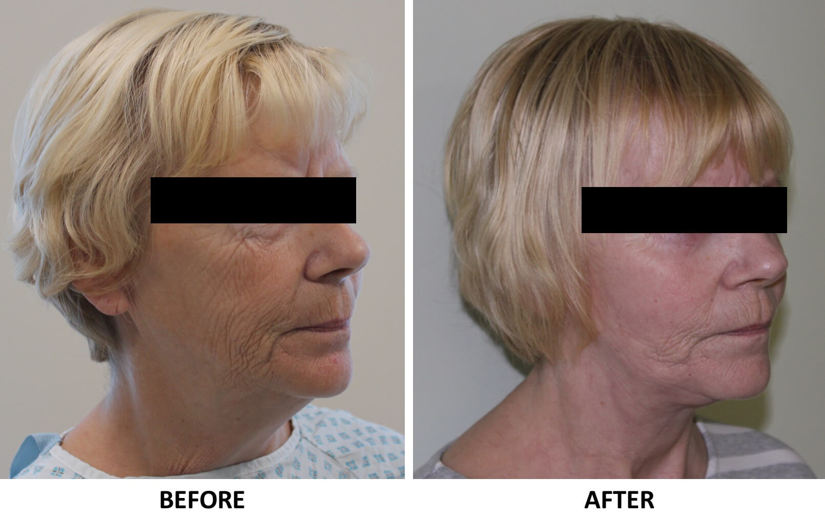 Facelift necklift right oblique view