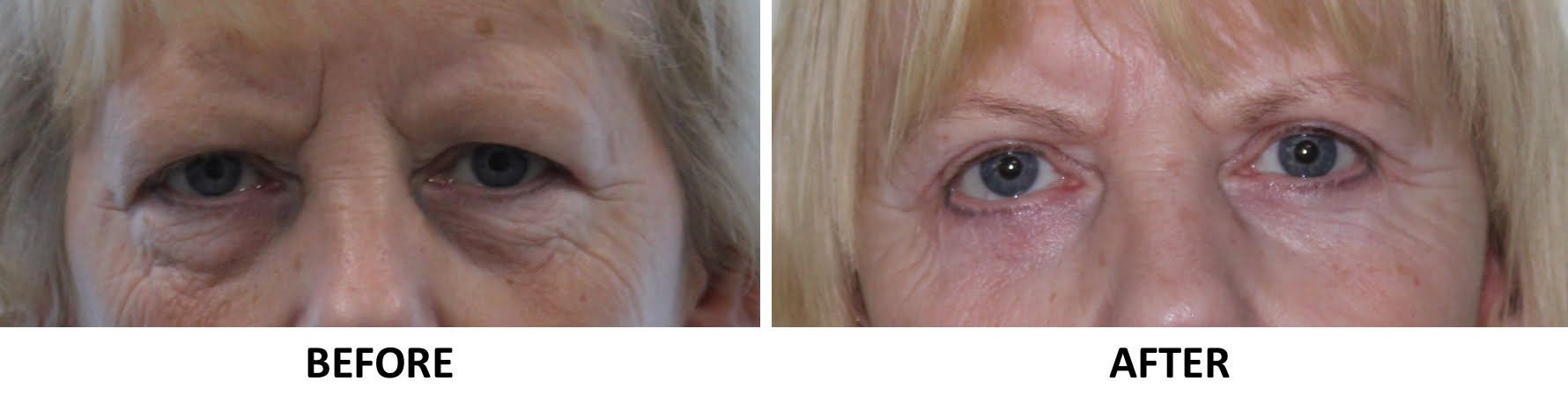 Upper eyelid surgery lower eyelid surgery AP view