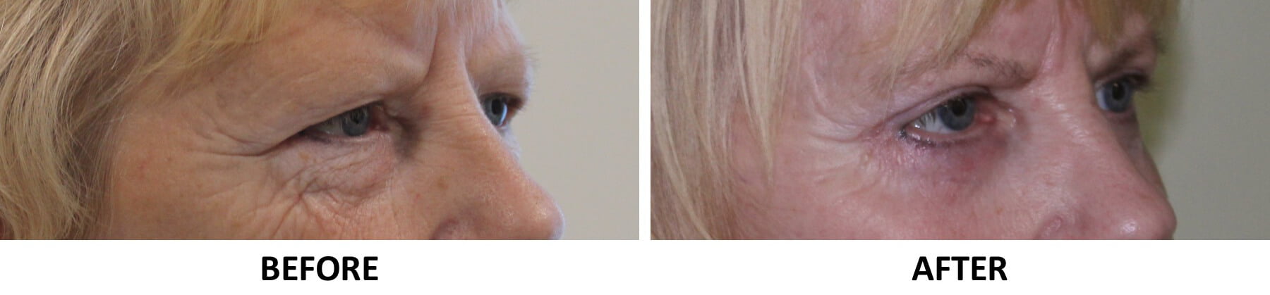 Upper eyelid surgery lower eyelid surgery right oblique view