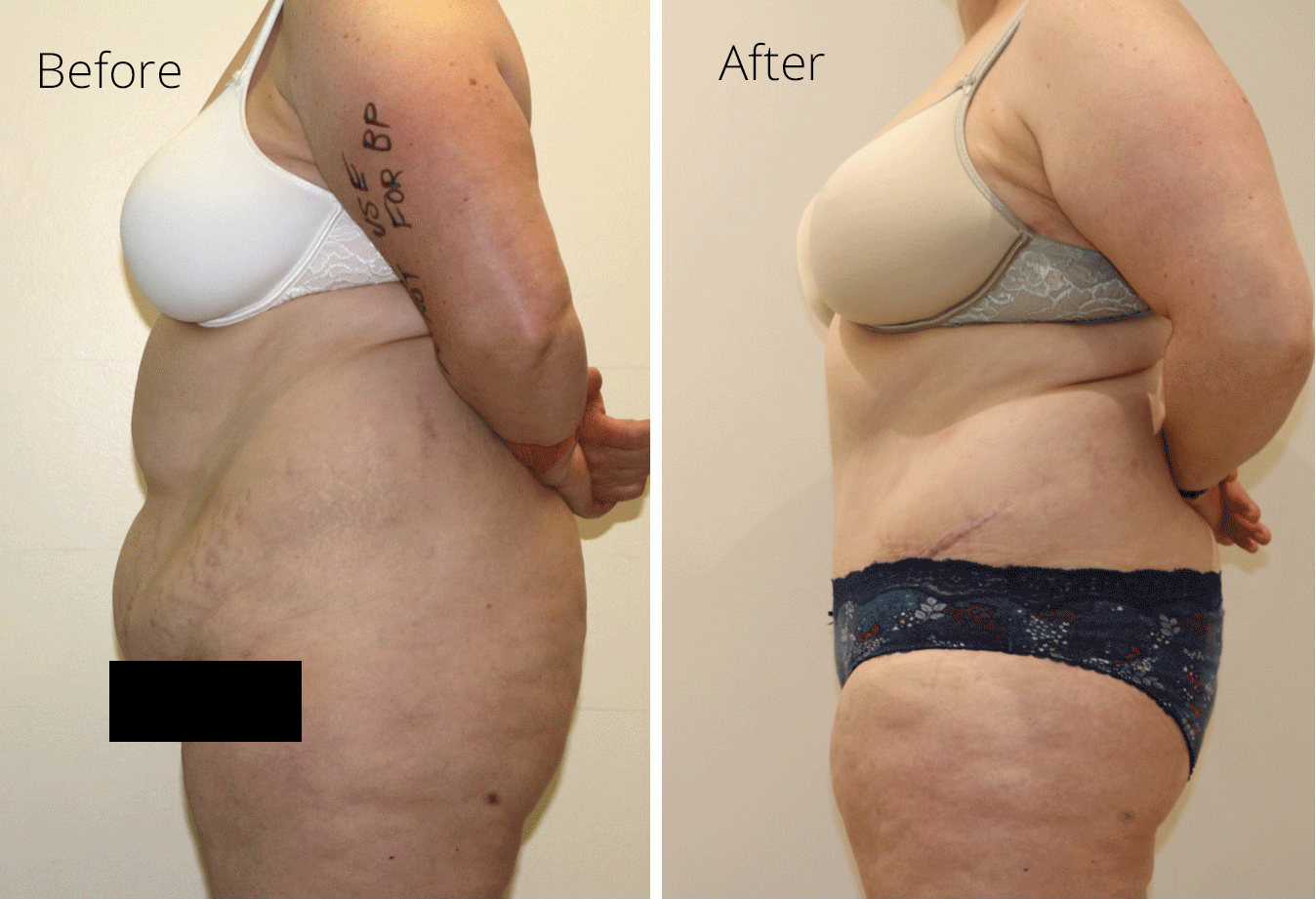 Brazilian tummy tuck before and after photos left lateral view web