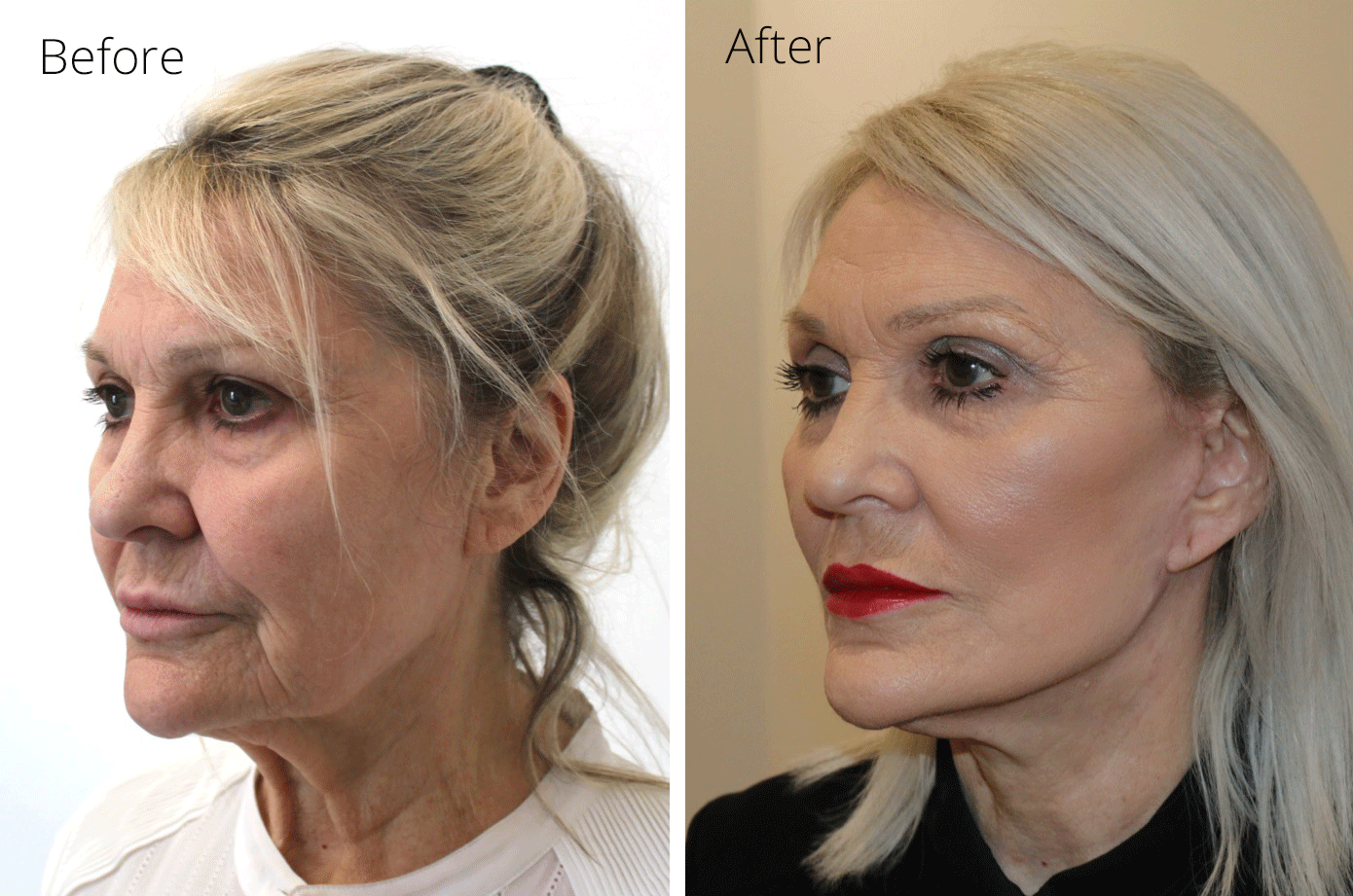 Facelift necklift before and after photos left oblique view