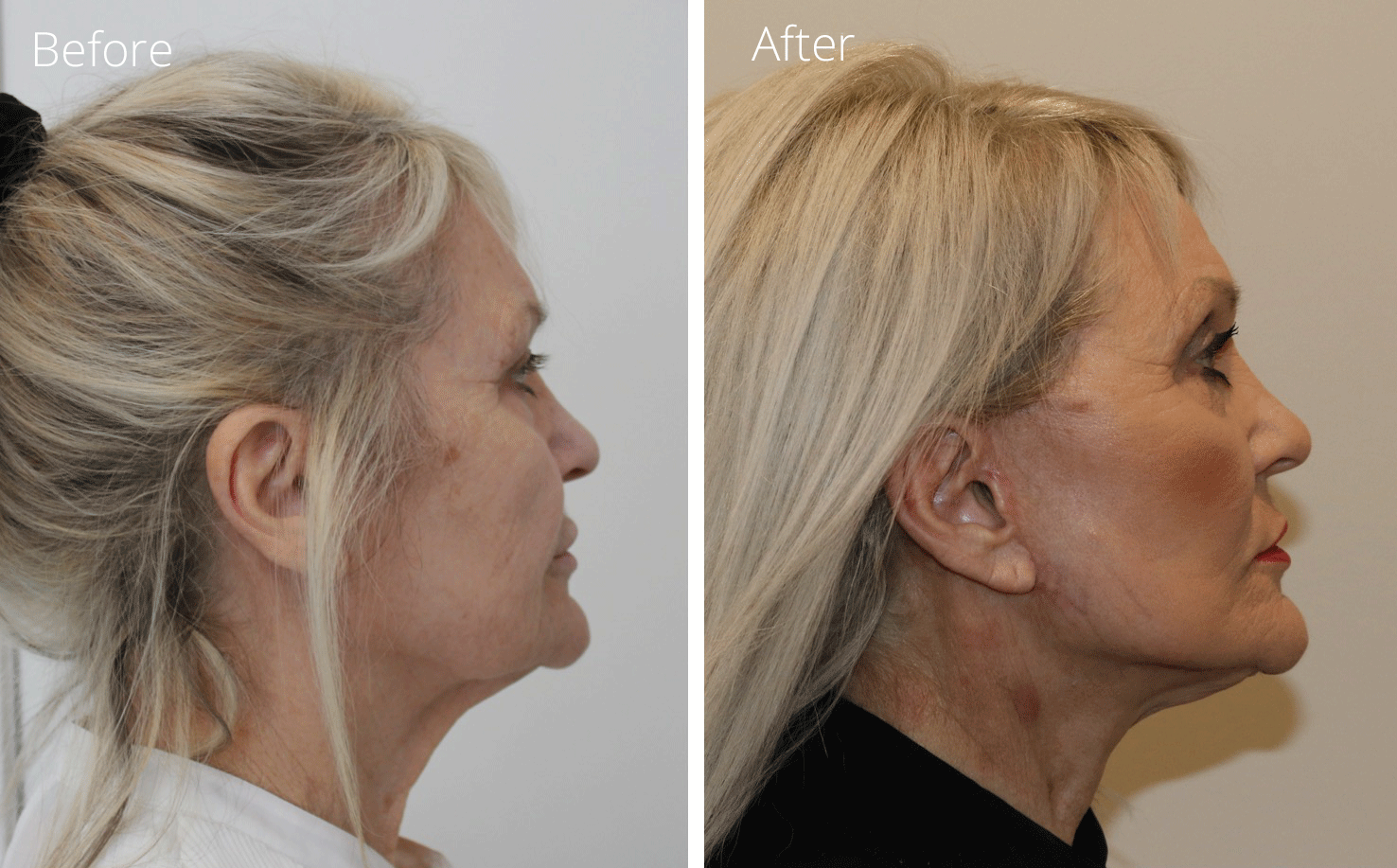Facelift necklift before and after photos right lateral view