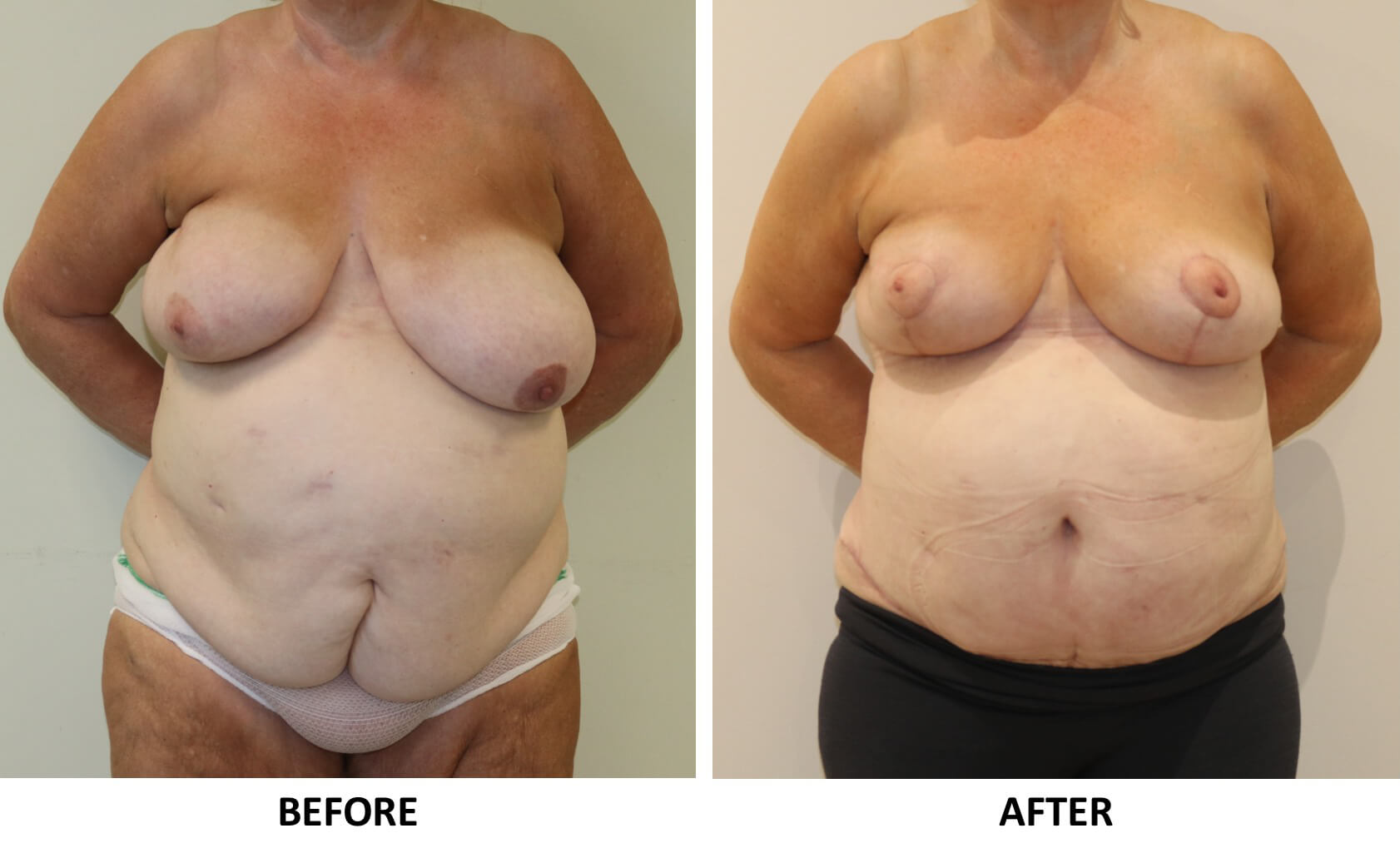 Symmetrising breast reduction and Brazilian tummy tuck AP view