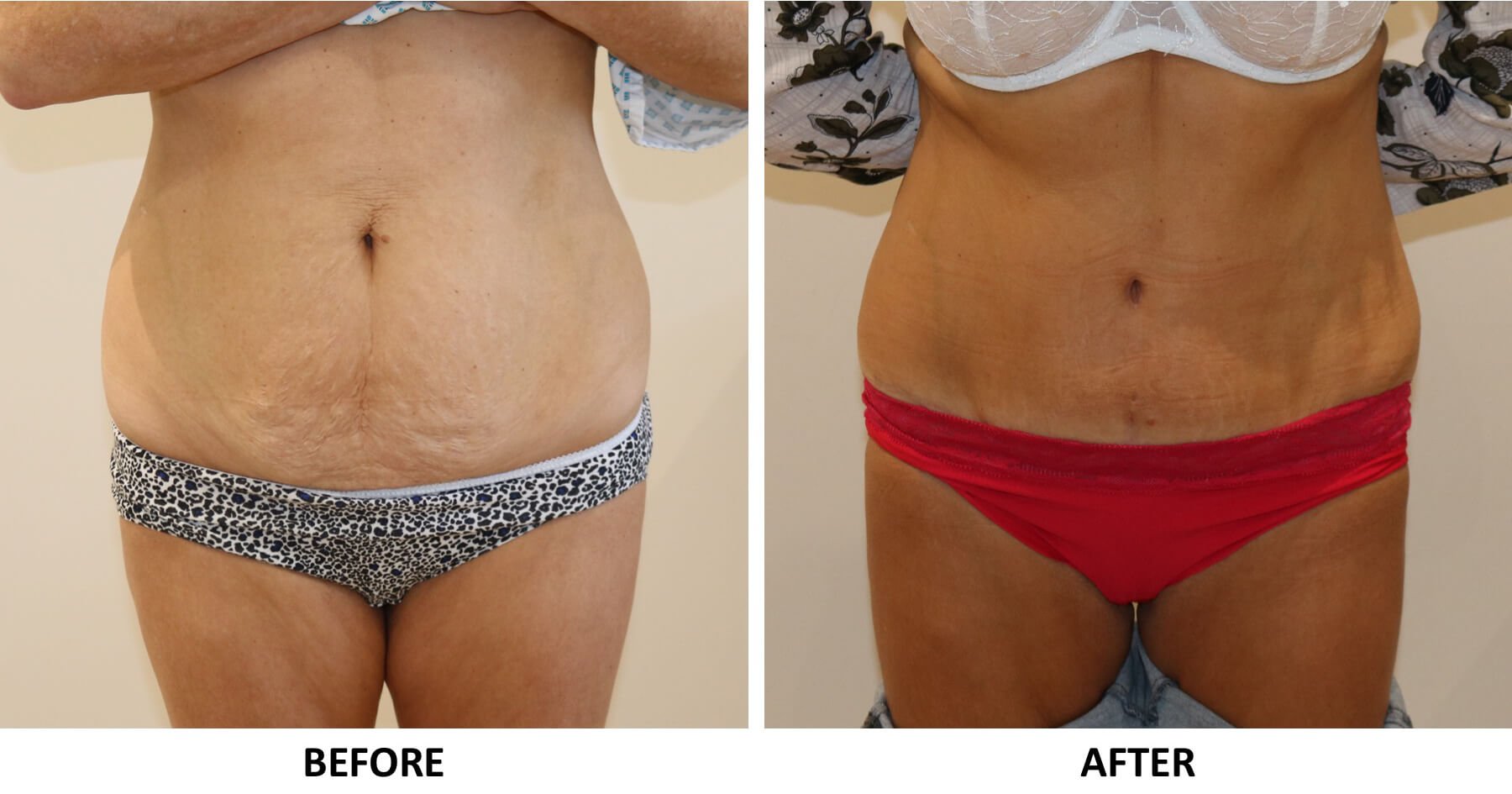 Tummy tuck abdominoplasty AP view