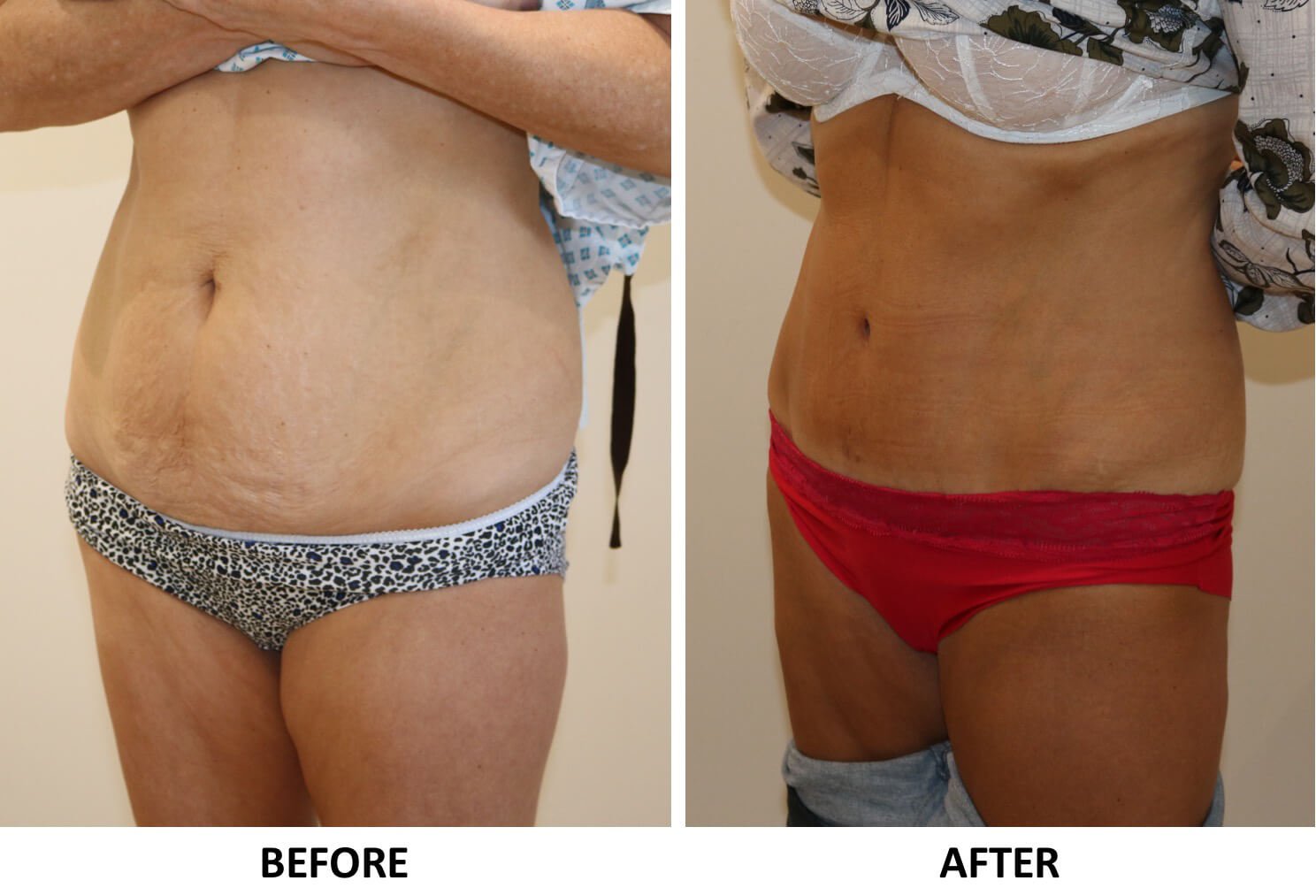 Tummy tuck (abdominoplasty) left oblique view
