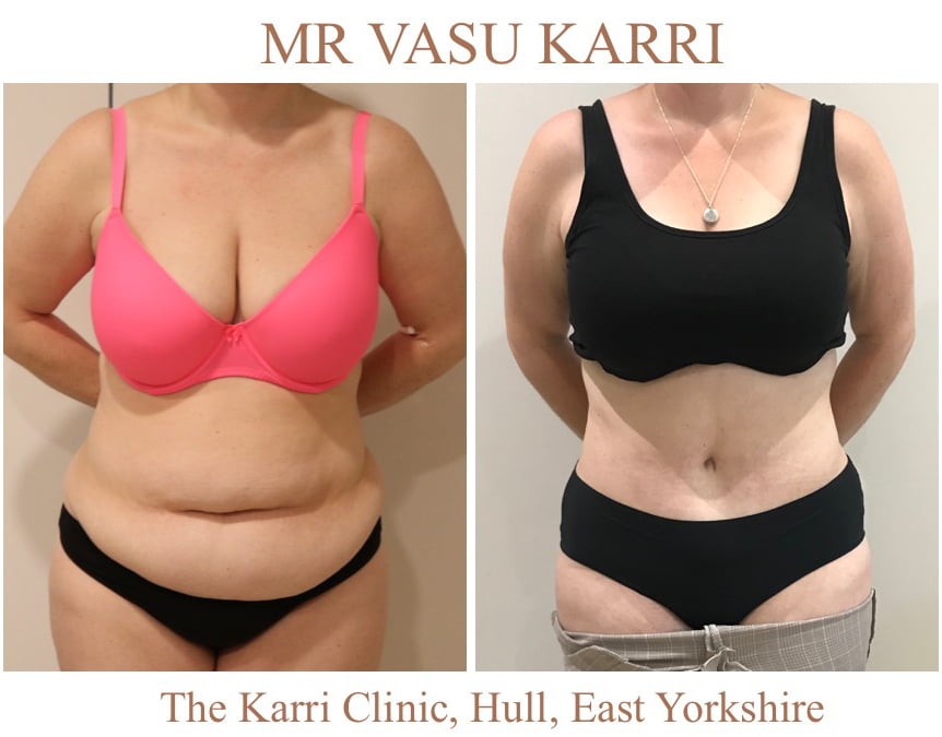 Brazilian tummy tuck Lipo abdominoplasty Mr Vasu Karri The Karri Clinic Tummy tuck before and after photo 1