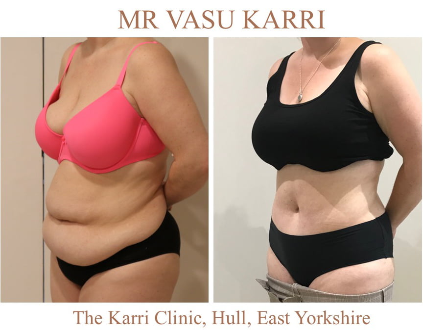 Brazilian tummy tuck Lipo abdominoplasty Mr Vasu Karri The Karri Clinic Tummy tuck before and after photo 2