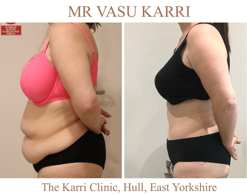 Brazilian tummy tuck Lipo abdominoplasty Mr Vasu Karri The Karri Clinic Tummy tuck before and after photo 3