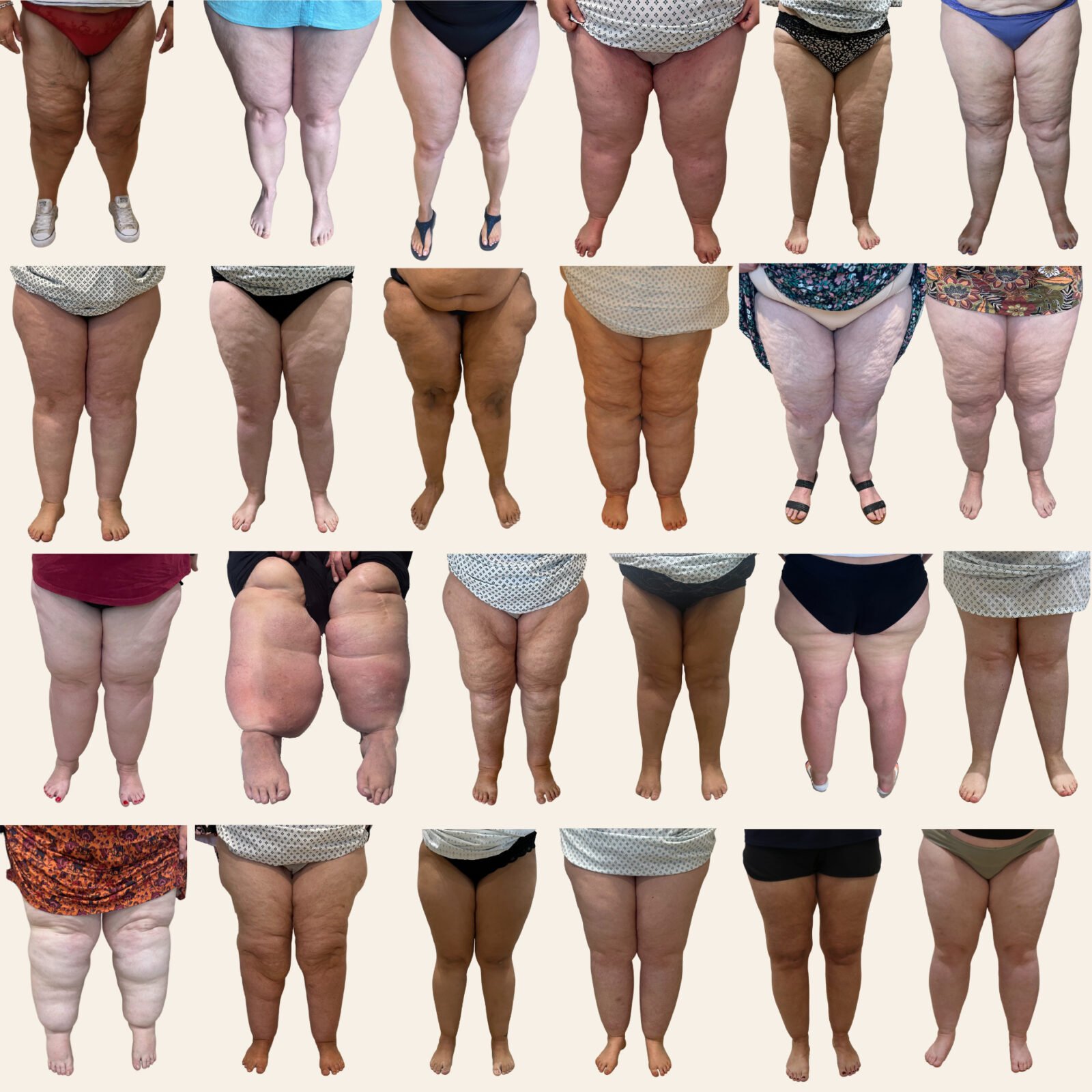 Lipoedema legs Mr Vasu Karri The Karri Clinic